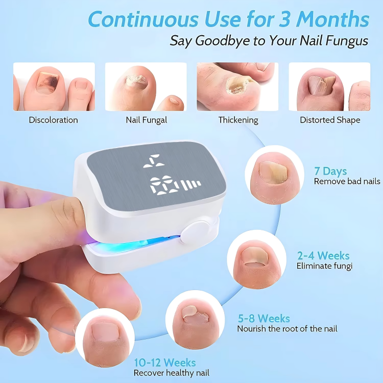 FungiZap™ — Effortless Laser Power to Restore Beautiful, Healthy Nails Pain-Free