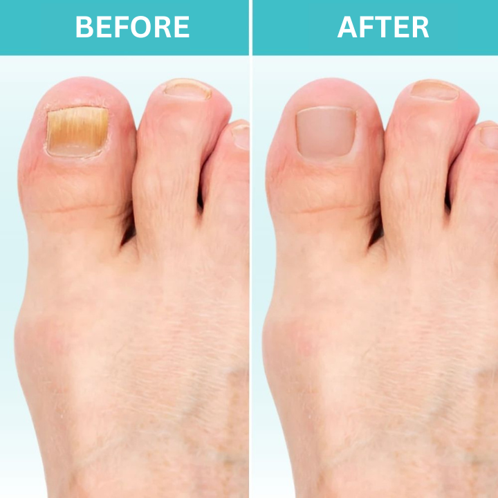 FungiZap™ — Effortless Laser Power to Restore Beautiful, Healthy Nails Pain-Free