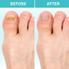 FungiZap™ — Effortless Laser Power to Restore Beautiful, Healthy Nails Pain-Free