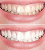 1+1 Free | FlashBright™ — Instantly Light Up Your Smile with Gentle, Lasting Power