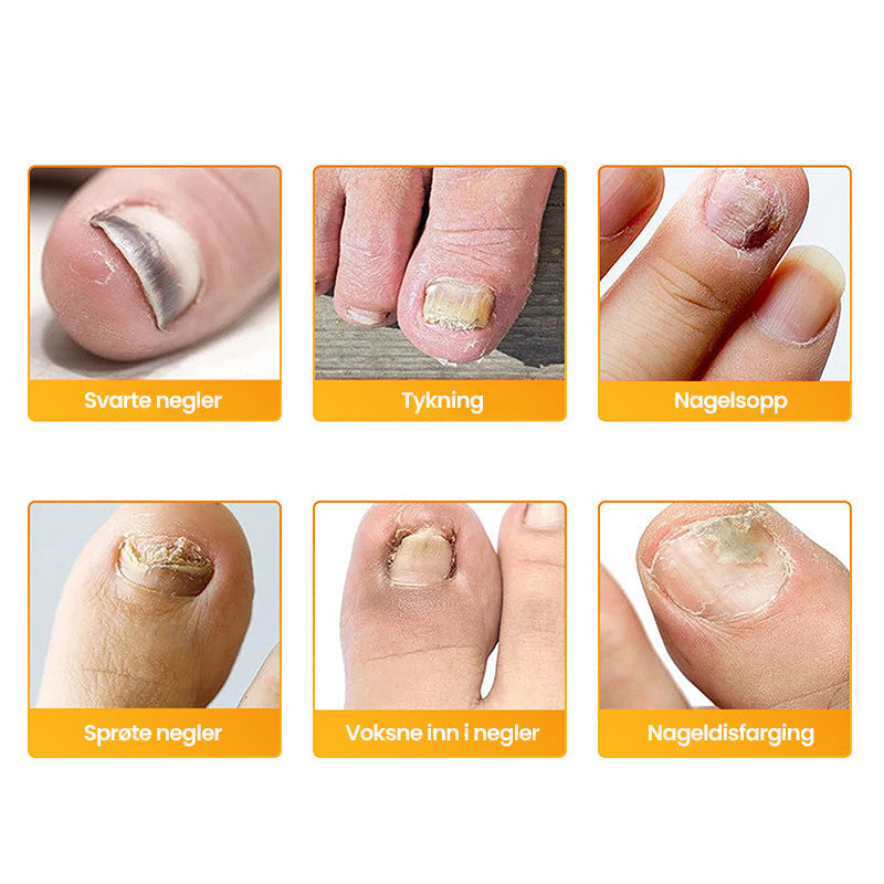 FungiZap™ — Invisible Power for Healthy, Flawless Nails You Can Be Proud of Again | 1+1 Free