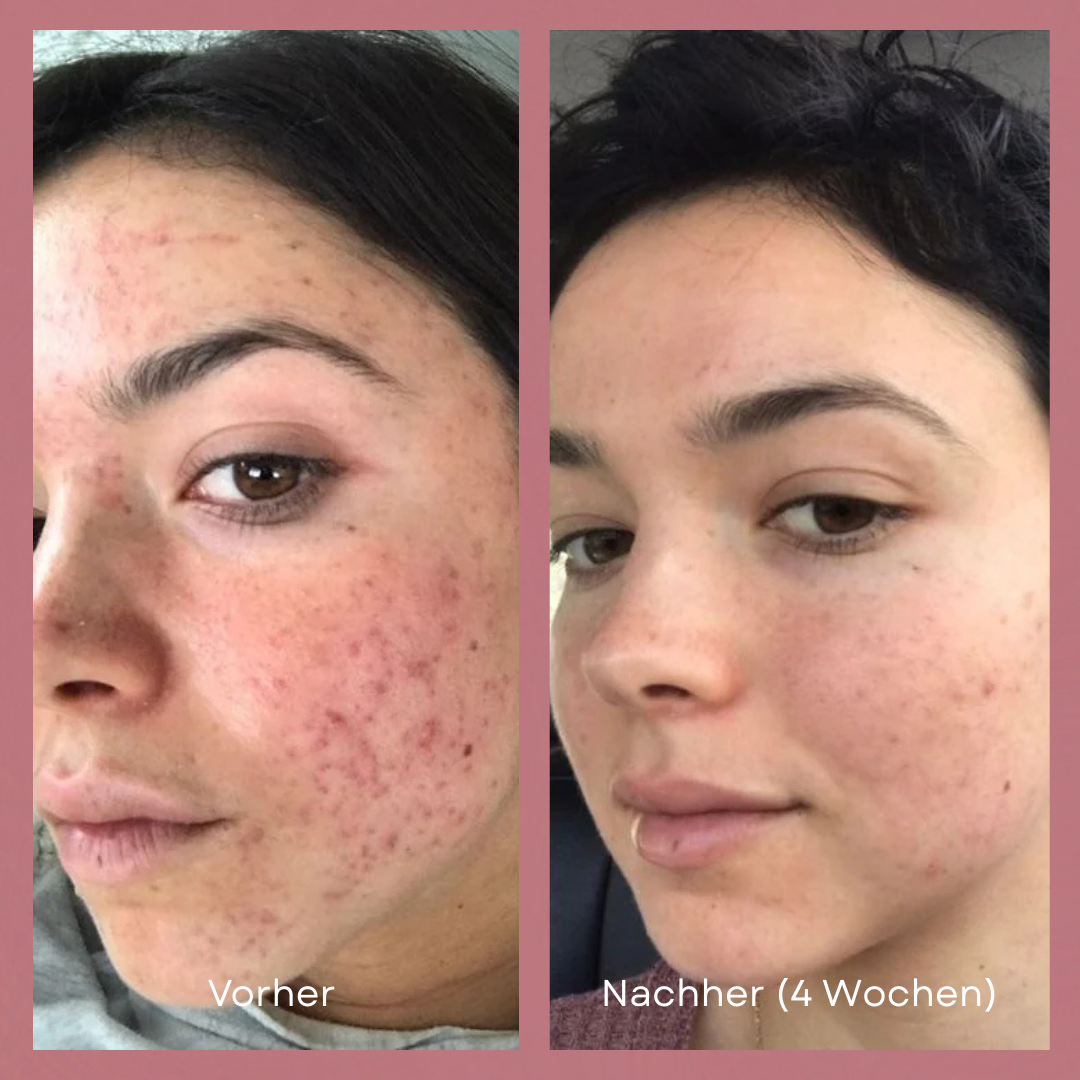 Lumi LED Mask™ — Glow Effortlessly with Salon-Quality Skin in Minutes a Day