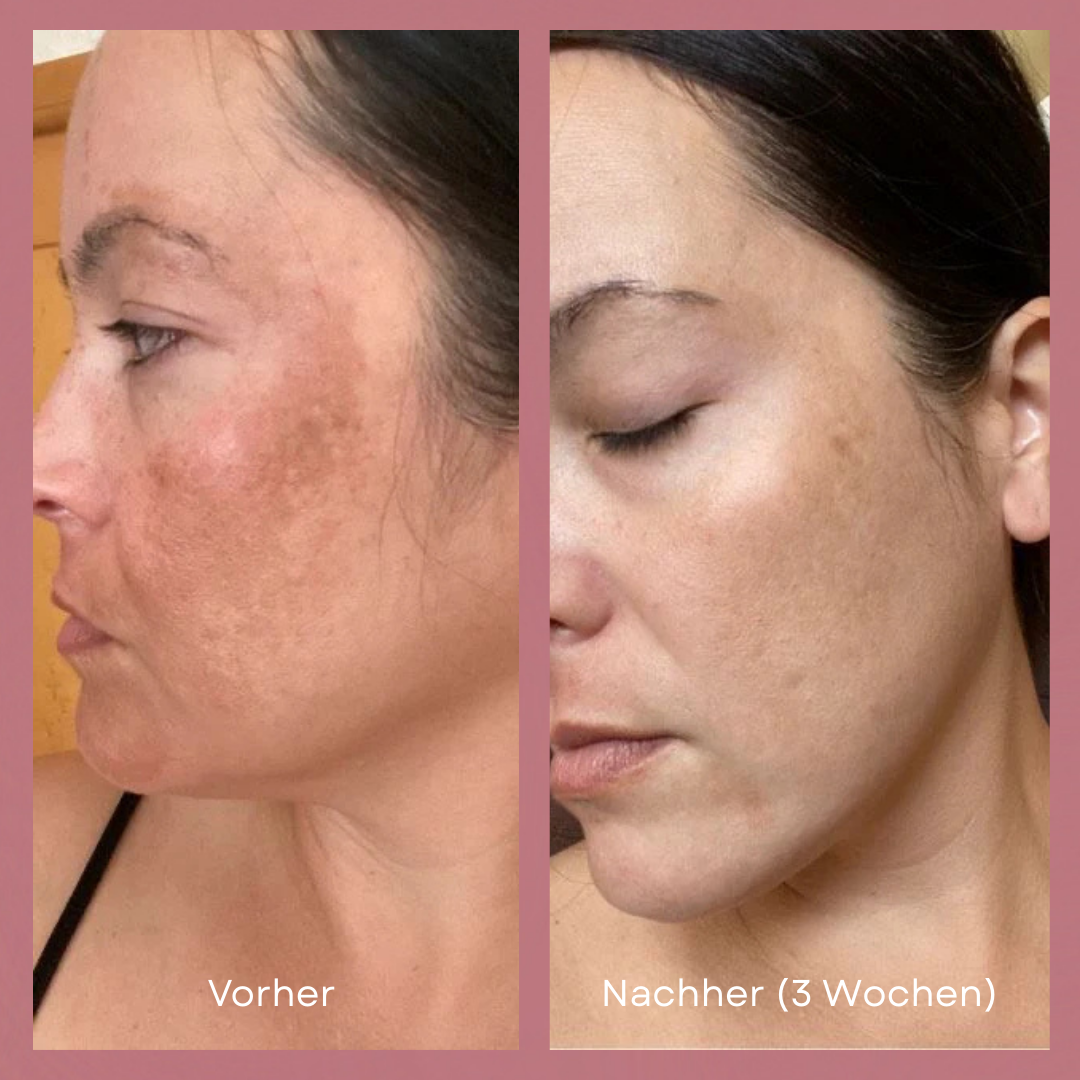 Lumi LED Mask™ — Glow Effortlessly with Salon-Quality Skin in Minutes a Day