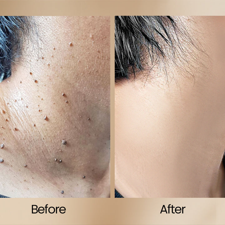 BUY ONE GET ONE FREE | BeeClear™ — Clear Away Skin Flaws to Reveal Your True Confidence