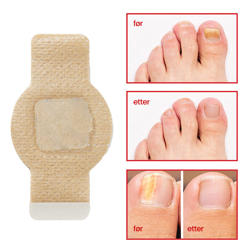FungiZap™ — Invisible Power for Healthy, Flawless Nails You Can Be Proud of Again | 1+1 Free