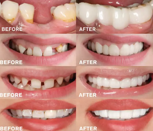 1+1 Free | VivaSmile™ — Snap on your perfect smile and own every moment
