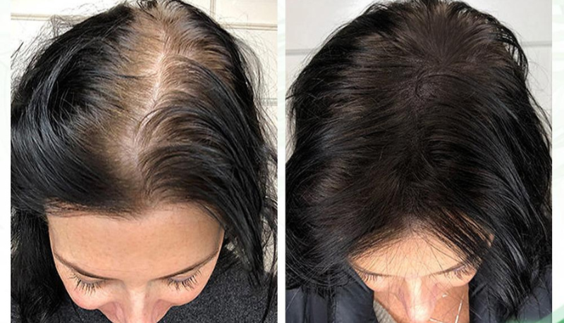 1+1 Free | Regrowth™ — Ignite Thick, Lush Hair Growth!