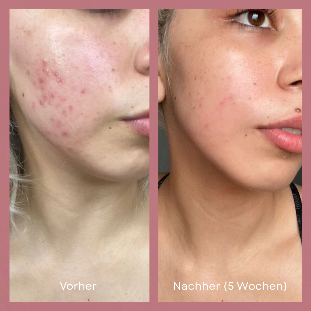 Lumi LED Mask™ — Glow Effortlessly with Salon-Quality Skin in Minutes a Day