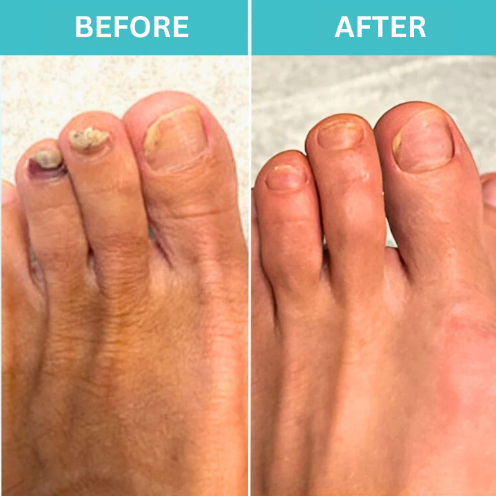 FungiZap™ — Effortless Laser Power to Restore Beautiful, Healthy Nails Pain-Free