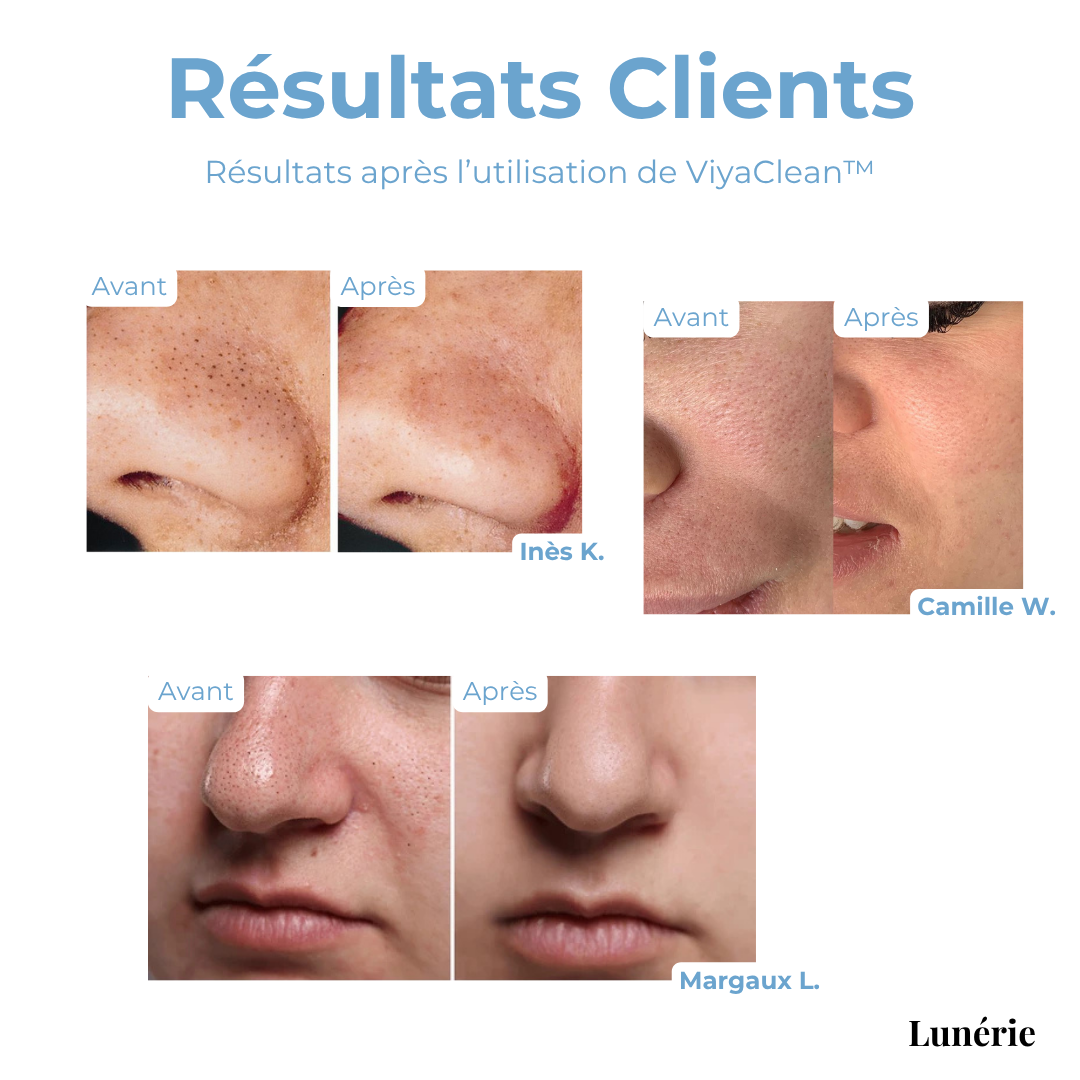 Anti-Blackhead Serum™ — Clear Away Blemishes to Reveal Smooth, Radiant Skin | 5+5 FREE