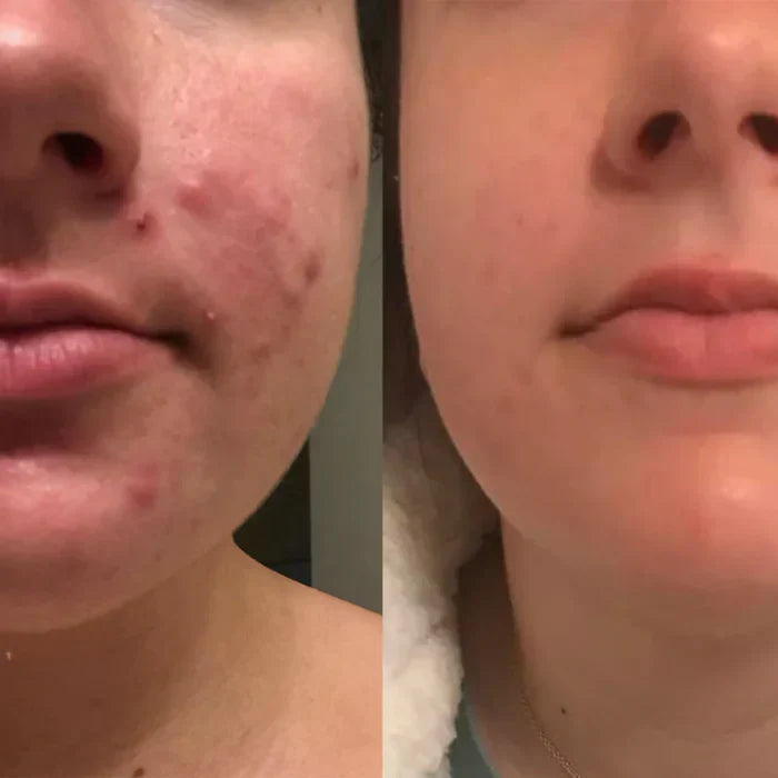 Buy One Get One Free | ScarGlow™ — Fade Scars Fast, Reveal Radiance!