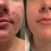 Buy One Get One Free | ScarGlow™ — Fade Scars Fast, Reveal Radiance!